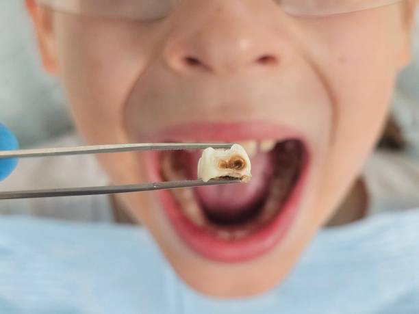Best Emergency Wisdom Tooth Extraction in Avoca, PA